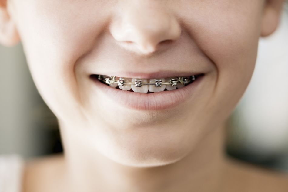 Mon enfant a des bagues dentaires : comment l'aider à les accepter 